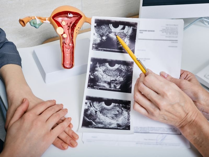 Tratamento da Sindrome do Ovario Policistico SOP em Curitiba